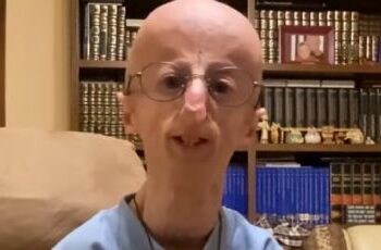 Muere a los 28 años Sammy Basso, la persona con envejecimiento prematuro más longeva del mundo