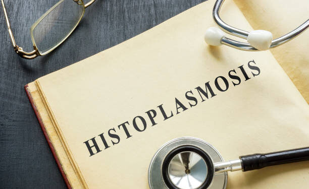 HISTOPLASMOSIS
